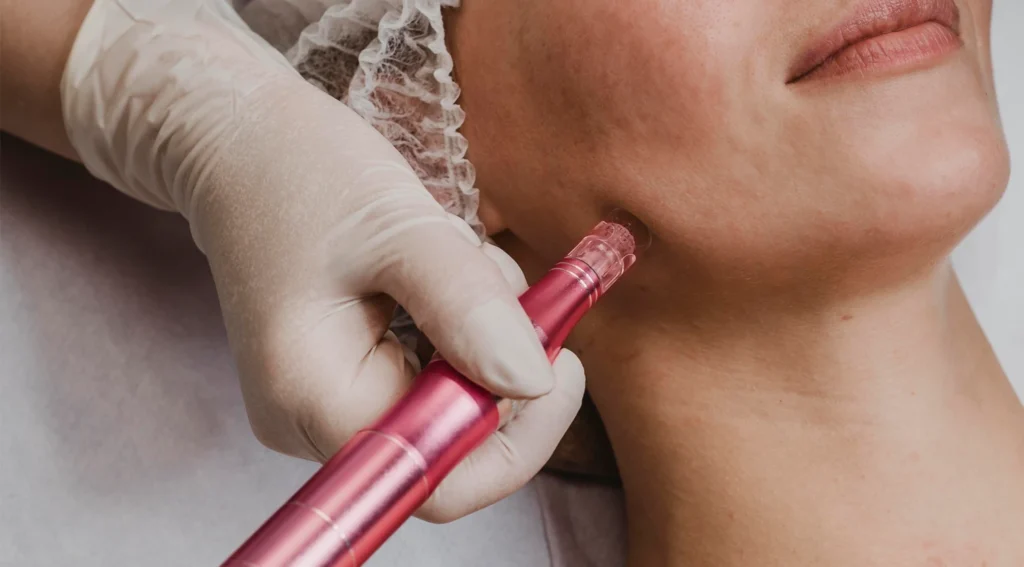 Primer plano de un tratamiento facial de microneedling; la mano de un profesional con guante blanco aplica un dispositivo Dermapen de color rosa sobre la línea de la mandíbula de una paciente.